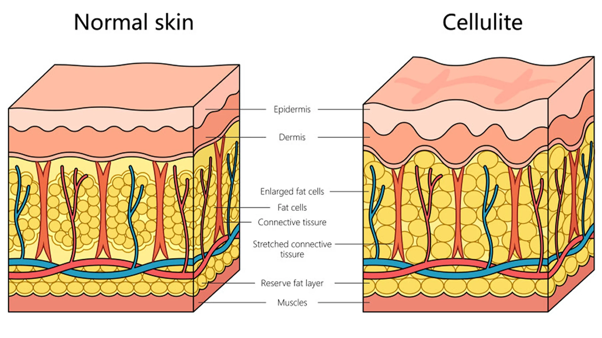 Structure of skin with cellulite